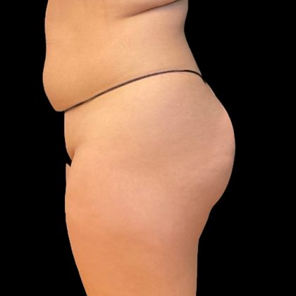 Brazilian Butt Lift Before & After Patient #8978