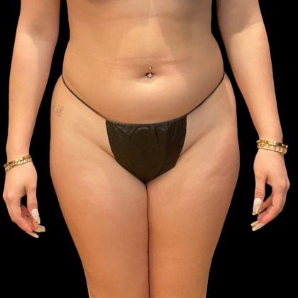 Brazilian Butt Lift Before & After Patient #8978