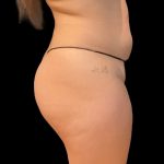 Brazilian Butt Lift Before & After Patient #8978
