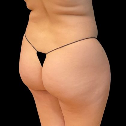 Brazilian Butt Lift Before & After Patient #8978