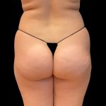 Brazilian Butt Lift Before & After Patient #8978