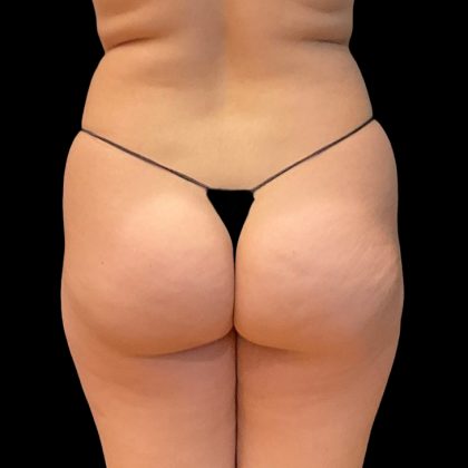 Brazilian Butt Lift Before & After Patient #8978
