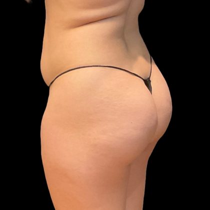 Brazilian Butt Lift Before & After Patient #8978
