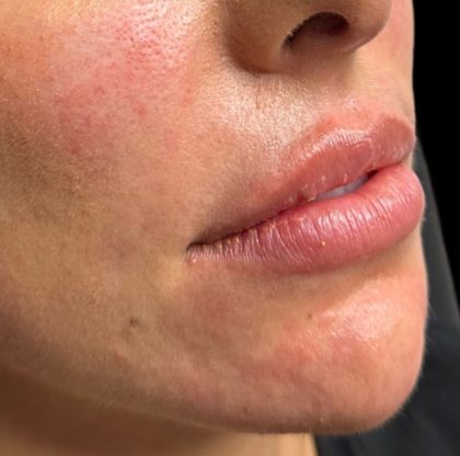 Lip Filler Before & After Patient #9573
