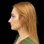 Rhinoplasty Before & After Patient #9602