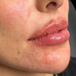 Lip Filler Before & After Patient #9573