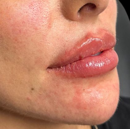 Lip Filler Before & After Patient #9573
