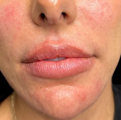 Lip Filler Before & After Patient #9573