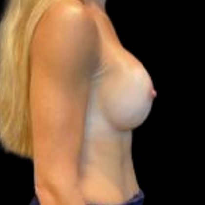 Breast Augmentation Before & After Patient #5410