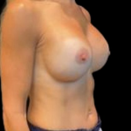 Breast Augmentation Before & After Patient #5410