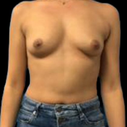 Breast Augmentation Before & After Patient #5439