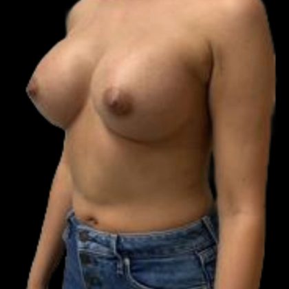Breast Augmentation Before & After Patient #5439
