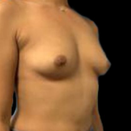 Breast Augmentation Before & After Patient #5439