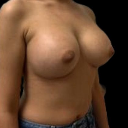 Breast Augmentation Before & After Patient #5439