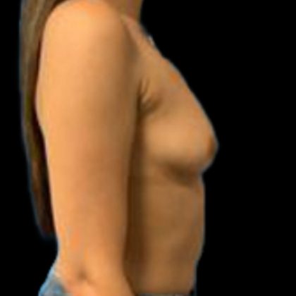 Breast Augmentation Before & After Patient #5439