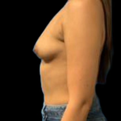 Breast Augmentation Before & After Patient #5439