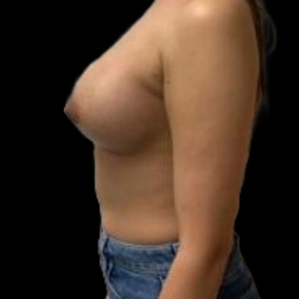 Breast Augmentation Before & After Patient #5439