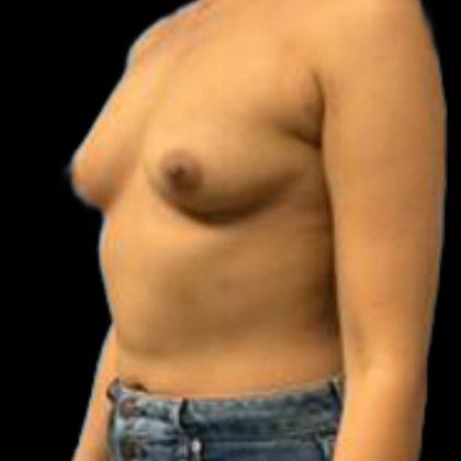 Breast Augmentation Before & After Patient #5439