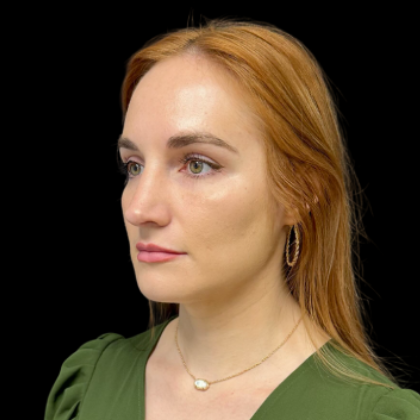 Rhinoplasty Before & After Patient #9602