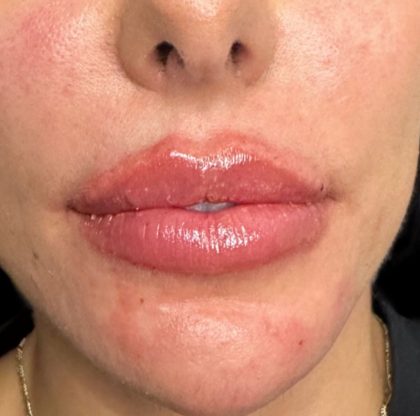 Lip Filler Before & After Patient #9573