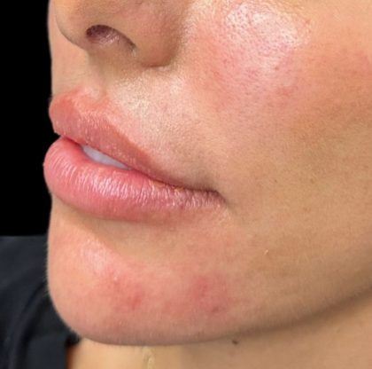 Lip Filler Before & After Patient #9573
