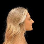 Liquid Rhinoplasty Before & After Patient #8076