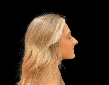 Liquid Rhinoplasty Before & After Patient #8076