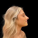 Liquid Rhinoplasty Before & After Patient #8076
