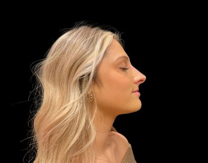 Liquid Rhinoplasty Before & After Patient #8076