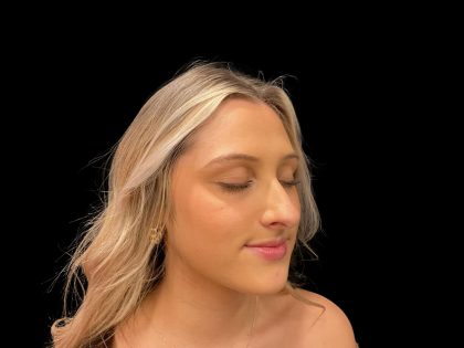 Liquid Rhinoplasty Before & After Patient #8076