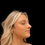 Liquid Rhinoplasty Before & After Patient #8076