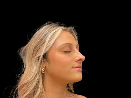 Liquid Rhinoplasty Before & After Patient #8076