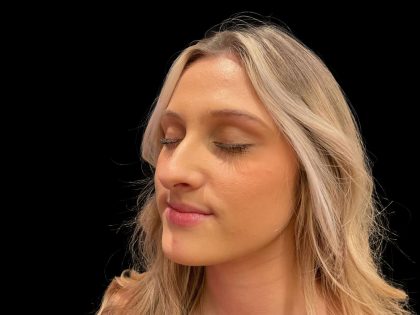 Liquid Rhinoplasty Before & After Patient #8076
