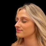 Liquid Rhinoplasty Before & After Patient #8076
