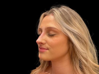 Liquid Rhinoplasty Before & After Patient #8076
