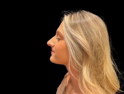 Liquid Rhinoplasty Before & After Patient #8076