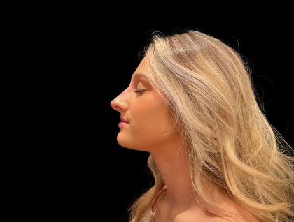 Liquid Rhinoplasty Before & After Patient #8076