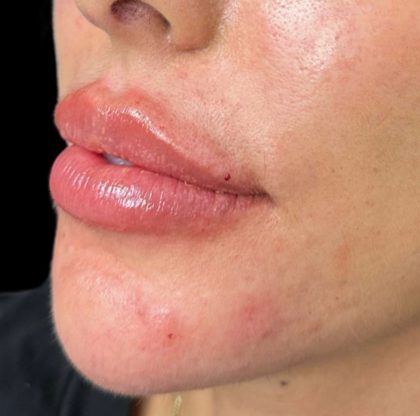 Lip Filler Before & After Patient #9573