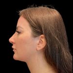 MyEllevate Before & After Patient #9492