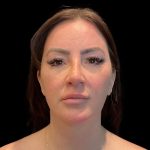 MyEllevate Before & After Patient #9492