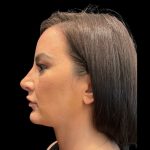 MyEllevate Before & After Patient #9492
