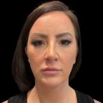 MyEllevate Before & After Patient #9492