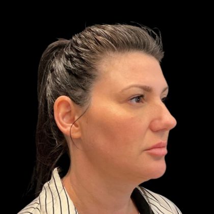 Blepharoplasty Before & After Patient #9405