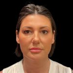 Blepharoplasty Before & After Patient #9405