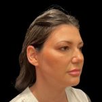 Blepharoplasty Before & After Patient #9405