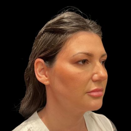 Blepharoplasty Before & After Patient #9405