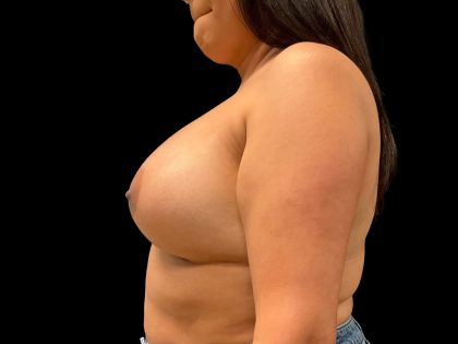 Breast Augmentation Before & After Patient #9434