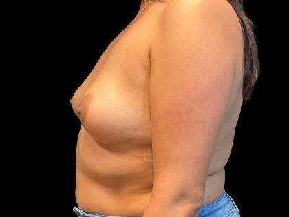 Breast Augmentation Before & After Patient #9434