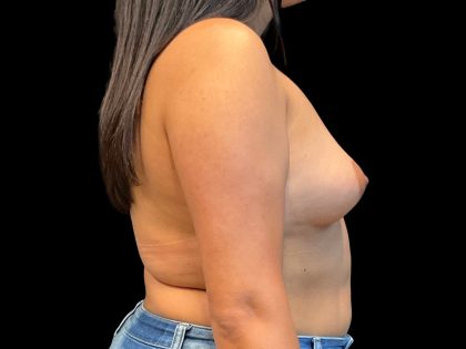 Breast Augmentation Before & After Patient #9434