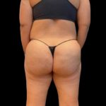 Aveli (Cellulite Removal) Before & After Patient #6433